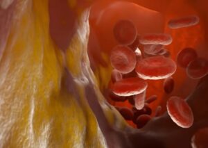 Reducción del Colesterol Reducción del Colesterol medicamentos