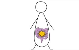 Diverticulosis Diverticulosis sintomas