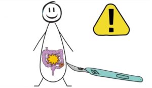 Diverticulosis Diverticulosis tratamiento